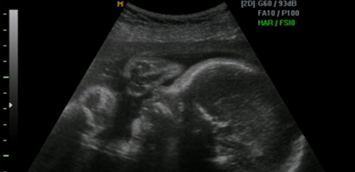screening for abnormalities-ultrasound